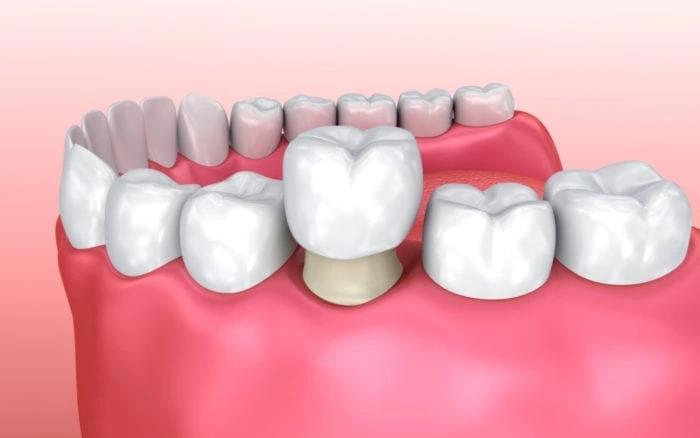 Dental Crowns